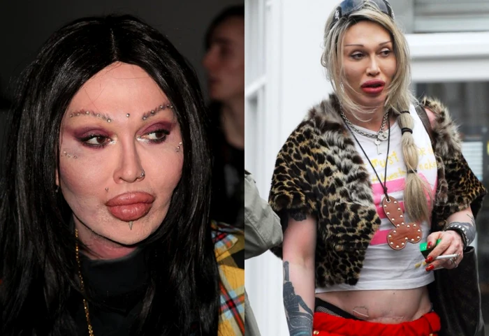 Pete Burns a suferit 300 de operaţii estetice.
