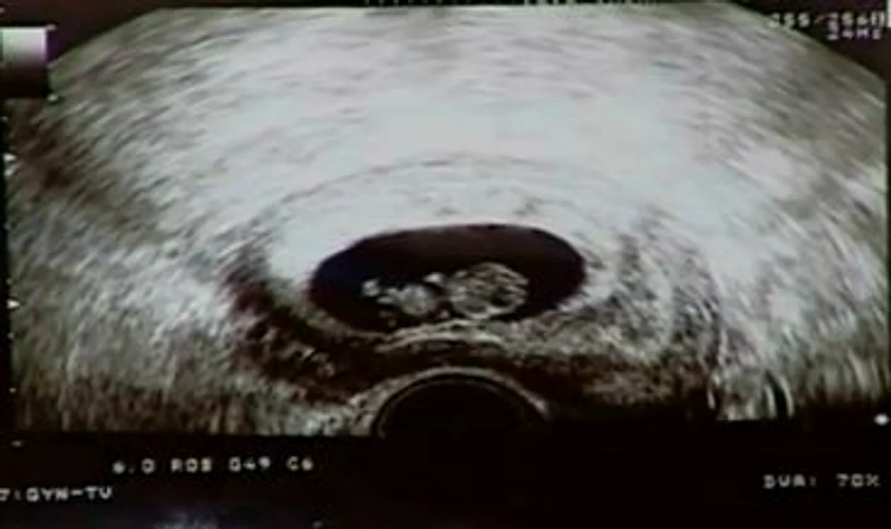 
    După trei operaţii de desfundare a trompelor şi şase fertilizări in vitro, Roxana Marinescu a rămas, în sfârşit, gravidă. Ea a adus, în emisiunea lui Teo Trandafir, ultima ecografieCaptură Kanal D  