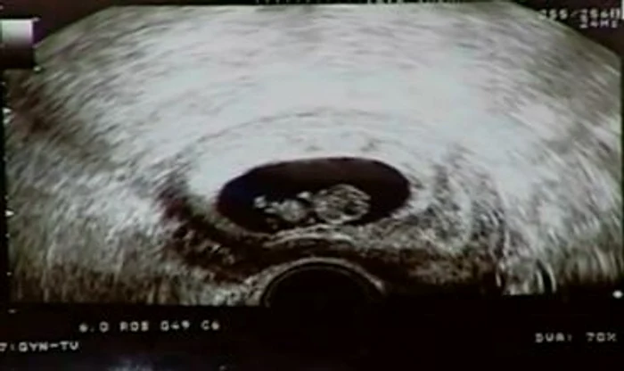 După trei operaţii de desfundare a trompelor şi şase fertilizări in vitro, Roxana Marinescu a rămas, în sfârşit, gravidă. Ea a adus, în emisiunea lui Teo Trandafir, ultima ecografieCaptură Kanal D