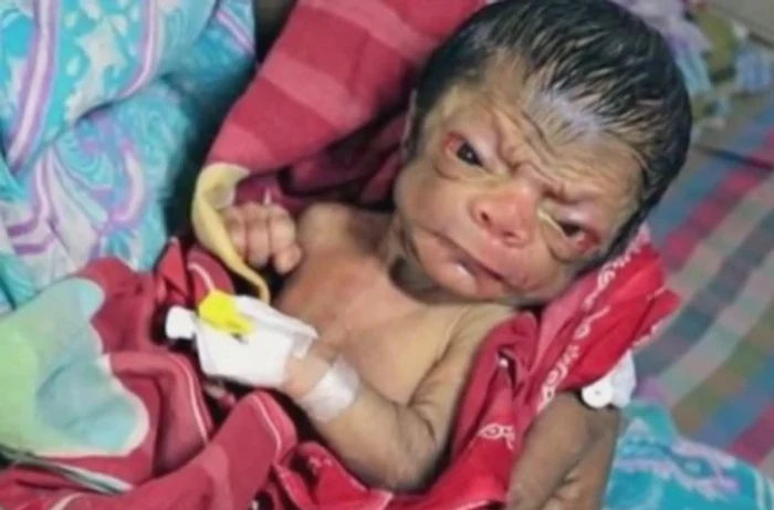 
    Bebelușul arată ca un bătrân din cauza unei boli geneticeFoto: captură video  