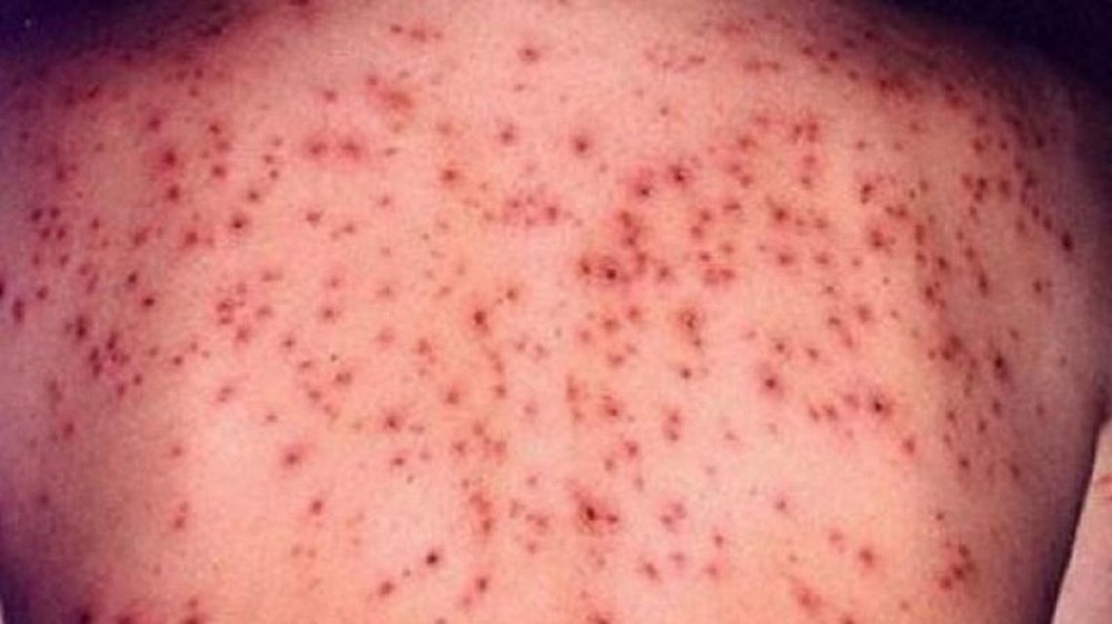 Efectele devastatoare ale rujeolei, explicate de specialiști. Tot mai mulți părinți refuză să-și vaccineze copiii