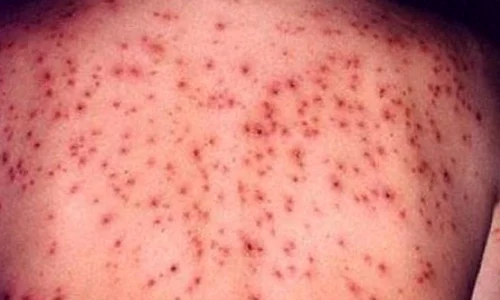 Cȃnd rujeola era un adevǎrat pojar pentru Romȃnia jpeg