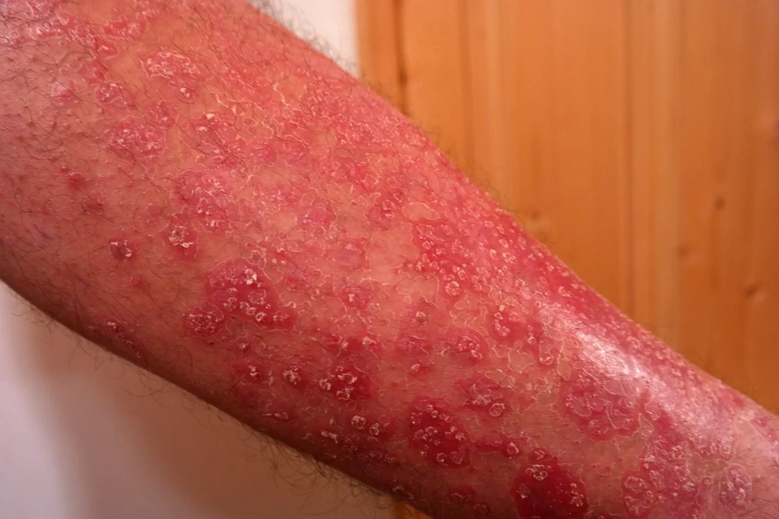 Psoriazisul se poate manifesta și sub forme mai severe