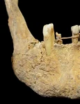 Maxilarul medieval dezvăluie cea mai veche punte dentară cunoscută din Scoția, realizată din aur de 20 de carate (© Jenna Dittmar / British Dental Journal (2026). DOI: 10.1038/s41415-025-9107-3)