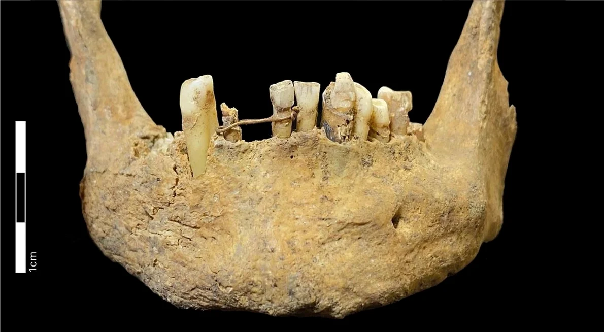 Maxilarul medieval dezvăluie cea mai veche punte dentară cunoscută din Scoția, realizată din aur de 20 de carate (© Jenna Dittmar / British Dental Journal (2026). DOI: 10.1038/s41415-025-9107-3)