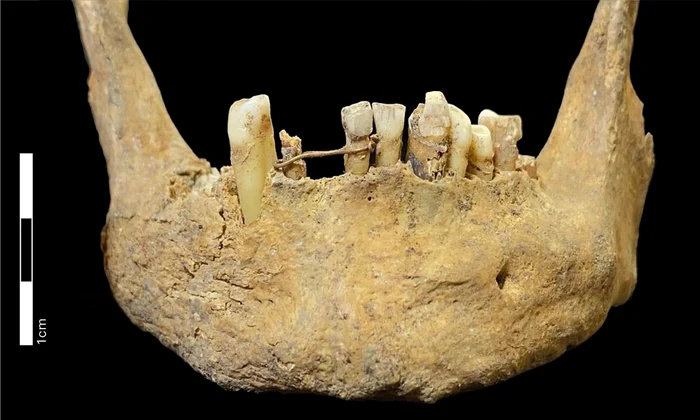 Maxilarul medieval dezvăluie cea mai veche punte dentară cunoscută din Scoția, realizată din aur de 20 de carate (© Jenna Dittmar / British Dental Journal (2026). DOI: 10.1038/s41415-025-9107-3)
