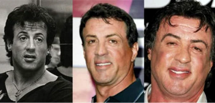 sylvester stallone operatie estetica