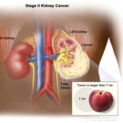 Cancerul de rinichi Foto National Cancer Institute jpg
