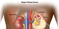 Cancerul de rinichi Foto National Cancer Institute jpg