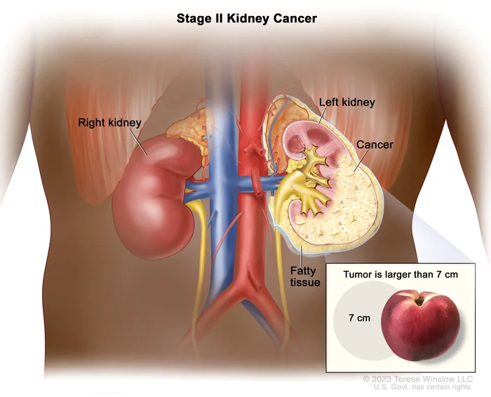 VIDEO Semnele subtile ale cancerului renal și vârsta de la care nu mai ai voie să le ignori: „E tot mai frecvent întâlnit la persoane tinere”
