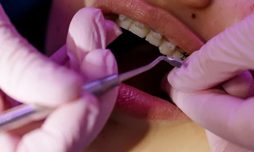 Tu stii cum se face igiena orala daca porti aparat dentar AFLA cateva sfaturi utile pentru tratamentul tau jpg