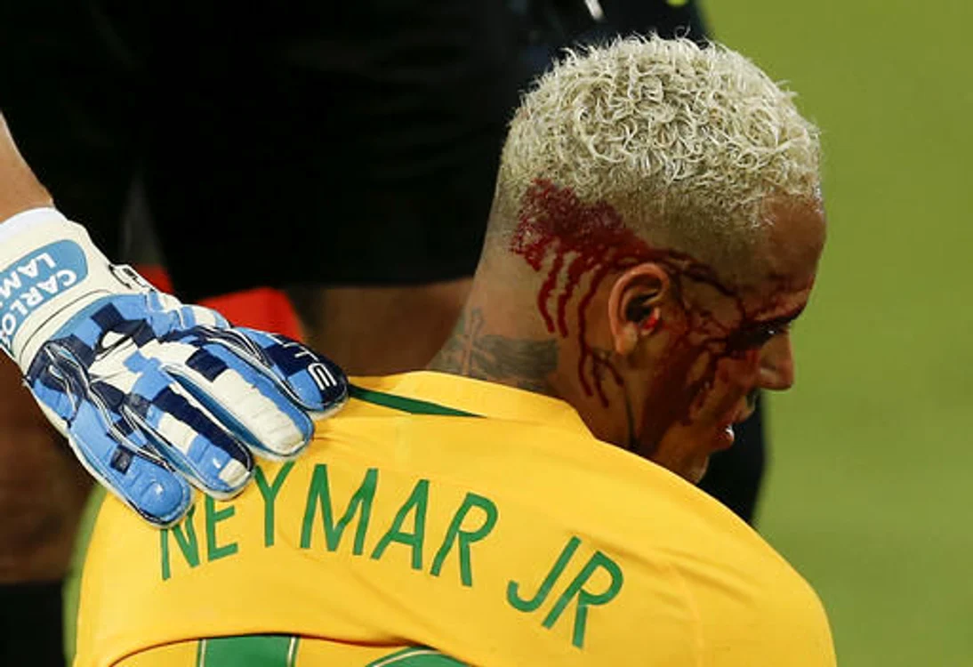 
    Neymar şi-a spart arcada  