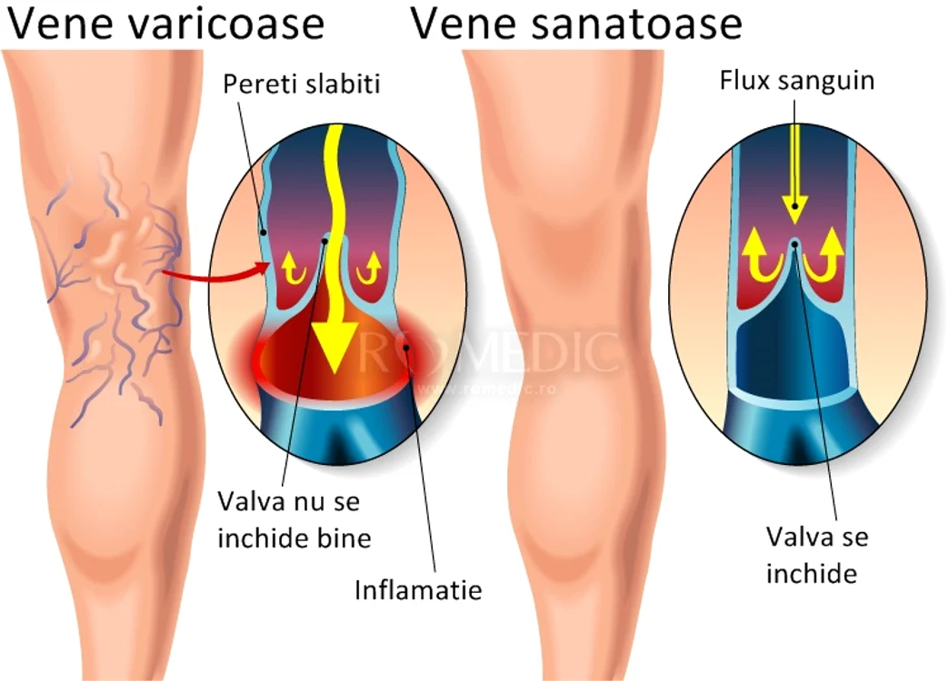 Varicele implică o circulaţie proastă a sângelui prin vene