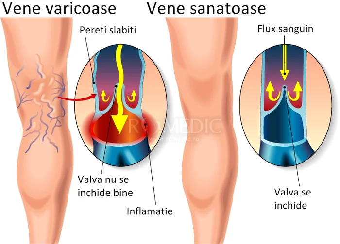 Varicele implică o circulaţie proastă a sângelui prin vene