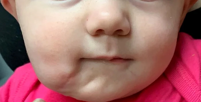 Așa arată bebelușul după ce a fost operat 