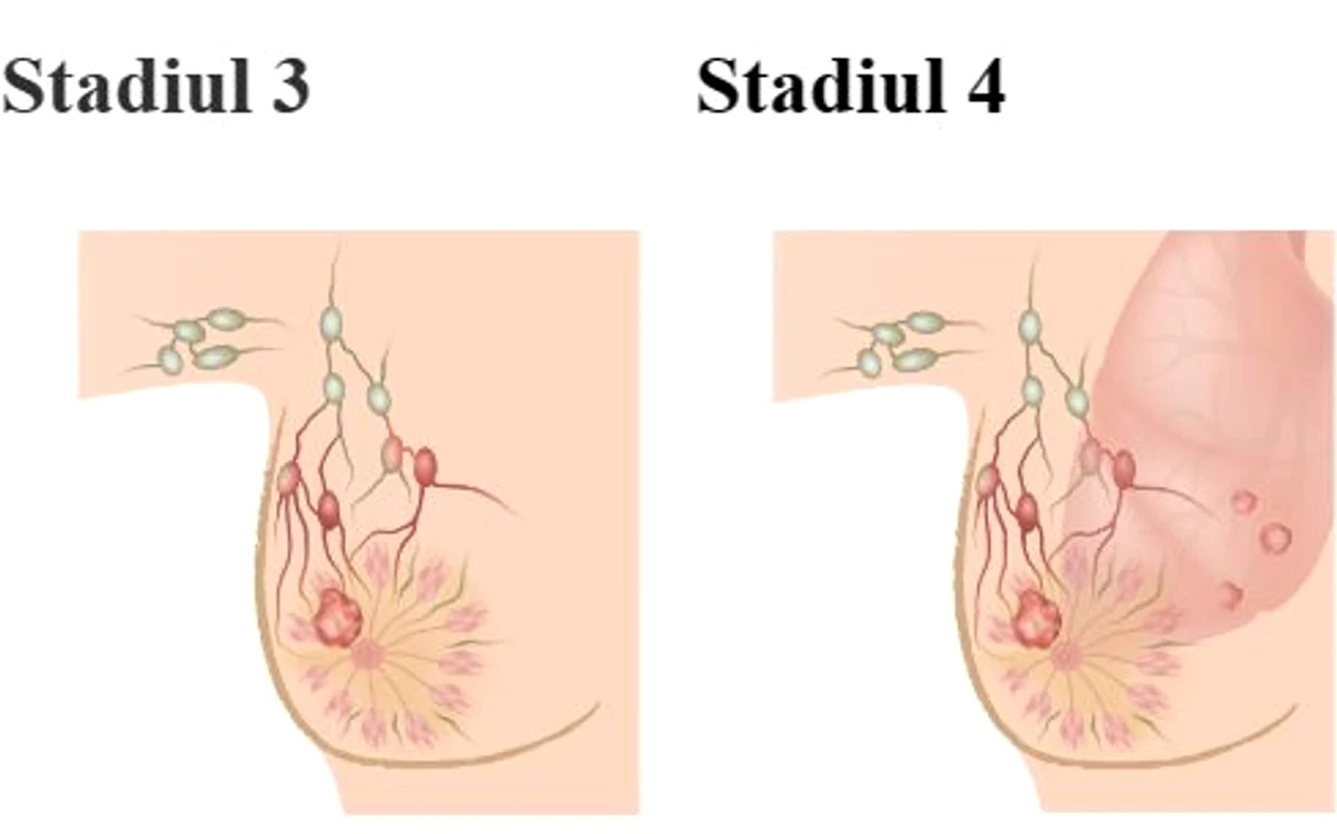 Stadii cancer. FOTO pentrutine.eu