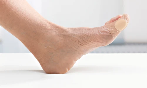 picior diabetic cauze riscuri tratament i preven ie1 jpg