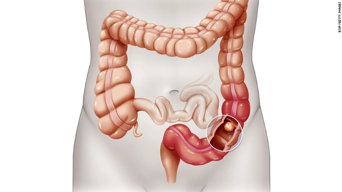 1 cancer colon jpg jpeg