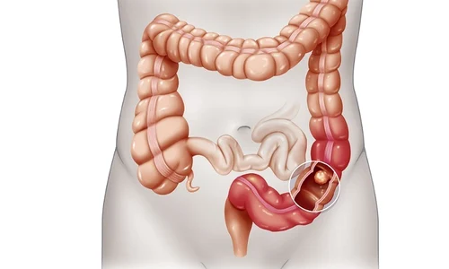 1 cancer colon jpg jpeg