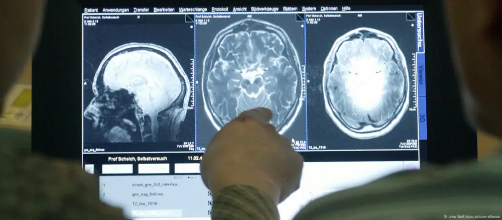 Medicament pentru Alzheimer: Lecanemab, aprobat în Europa  
