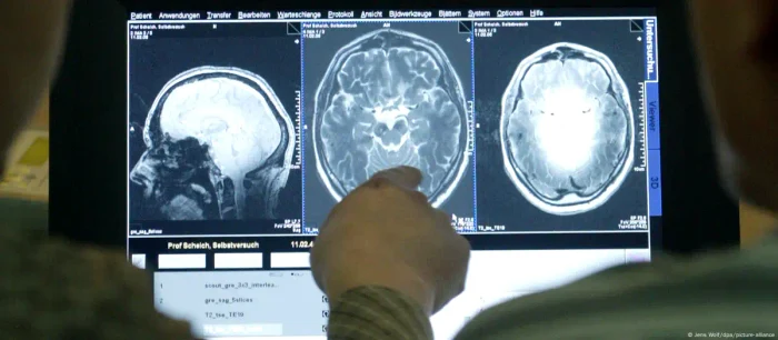 Imagini ale afecţiunilor neuronale identificate cu ajutorul tomografului