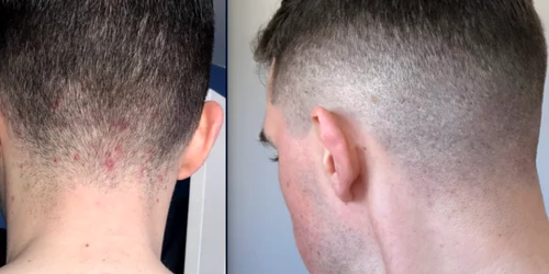 acnee scalp