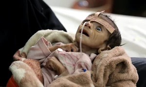 Udai Faisal, copilul ucis și desfigurat de malnutriție jpeg