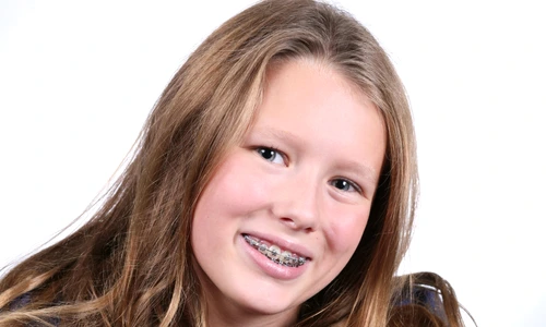 1 fata aparat dinti shutterstock 8124370 jpg jpeg