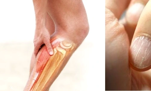 1 ai acnee ti se rup ungiile iti cade parul si ai dureri de stomac si de cap uite ce deficiente uriase ai in corp 47dn jpg jpeg