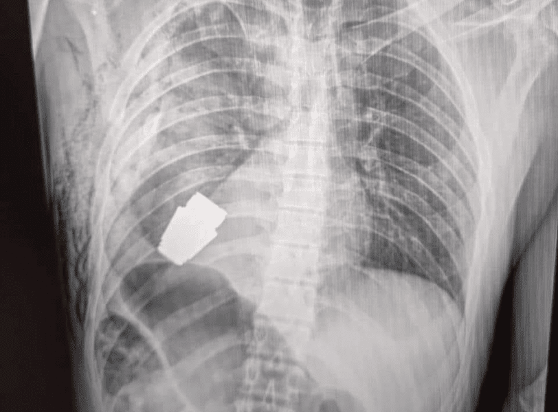 Medicii ucraineni au scos din corpul unui soldat o grenadă neexplodată