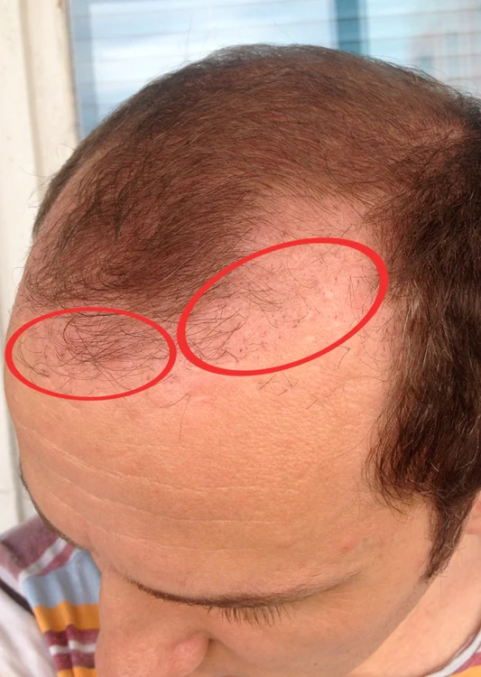 Părul lui Mihai a crescut cu 1 mm în două luni de la implant (foto: arhiva personală)