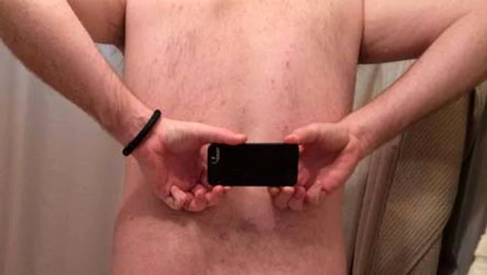 A rămas fără fese în urmei unei operaţii