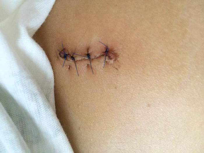 Așa arătau, la câteva săptămâni după atac, rănile de la sânii fetei