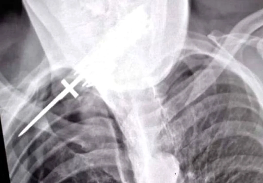 Radiografia realizată la spitalul din Suceava FOTO Dănuţ Zuzeac
