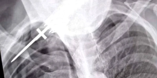 Un bărbat a ajuns la spital cu un cuţit înfipt în spate