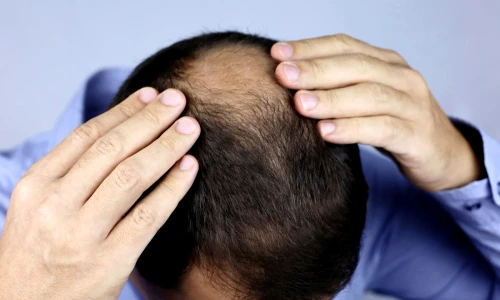 alopecie jpg