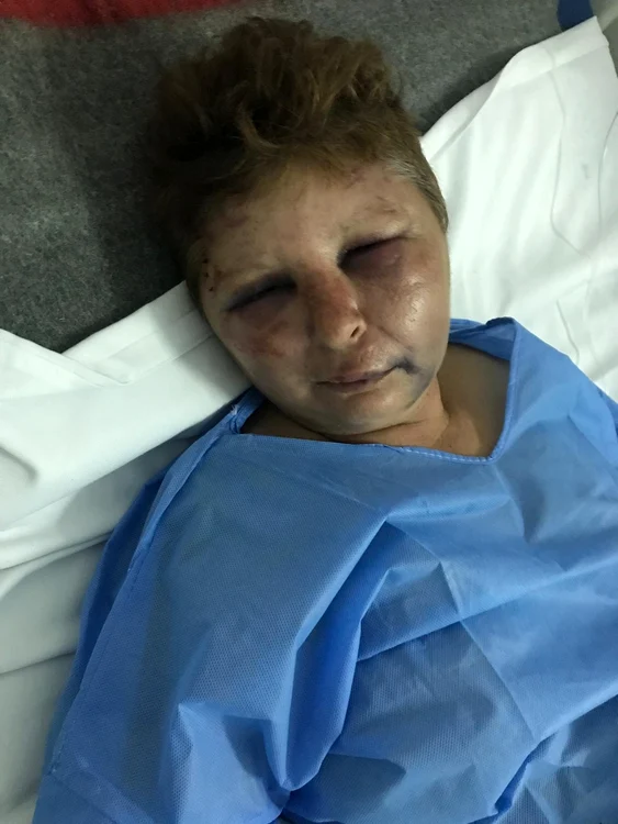 Femeia a fost bătută până la desfigurare