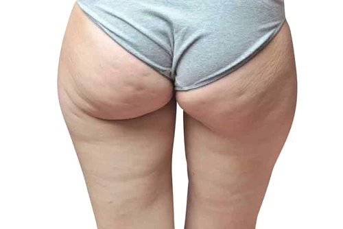 celulita infectioasa jpg jpeg