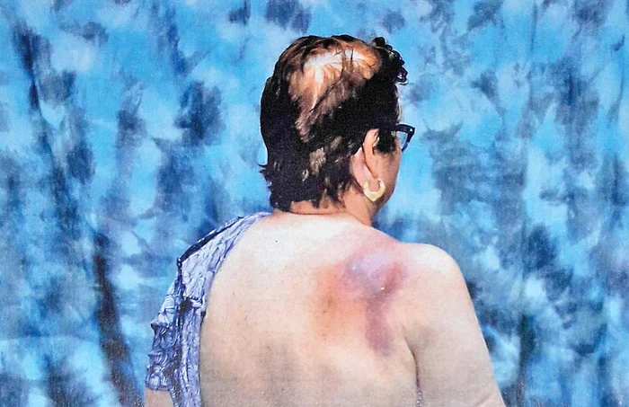 Aşa arăta  rana pe umărul  femeii