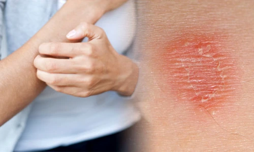 1 alergia cutanata jpg jpeg