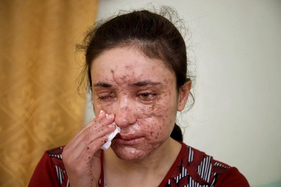 Lamiya Aji Bashar nu mai vede cu ochiul drept și are cicatrici pe chip din cauza exploziei minei