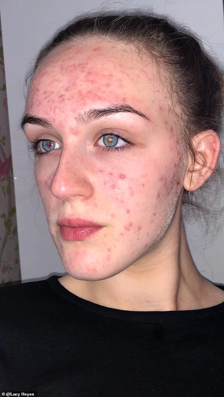 2 15230974 7179469 lucy heyes 19 from liverpool has praised a 6 cleansing bar conta a 55 1561472511564 jpg jpeg