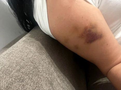 Așa arată acum mâna Ramonei Manole după ce a fost agresată de un necunoscut. Sursă: Click!