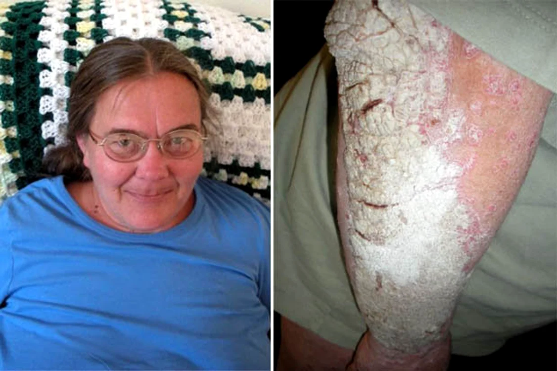 Pat Schuerman nu mai poate ieși din casă din cauza psoriazisului
