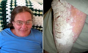 Pat Schuerman nu mai poate ieși din casă din cauza psoriazisului jpeg