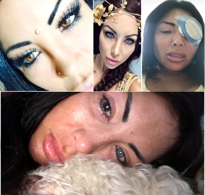 Un model de Instagram Naddine Bruna a rămas parțial oarbă în urma unei operații oculare Glasgowtimes