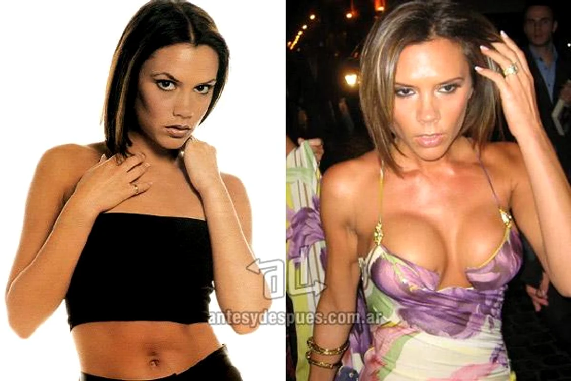 victoria beckham silicoane, vedete tunate, dive siliconate
