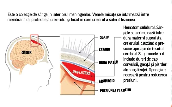 Hematomul subdural