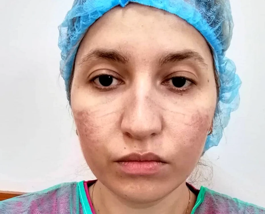 Medicul Carinna Andrada Morlova a postat o poză în care se văd urmele măştii de protecţie  FOTO: Facebook/ Carinna Andrada Morlova