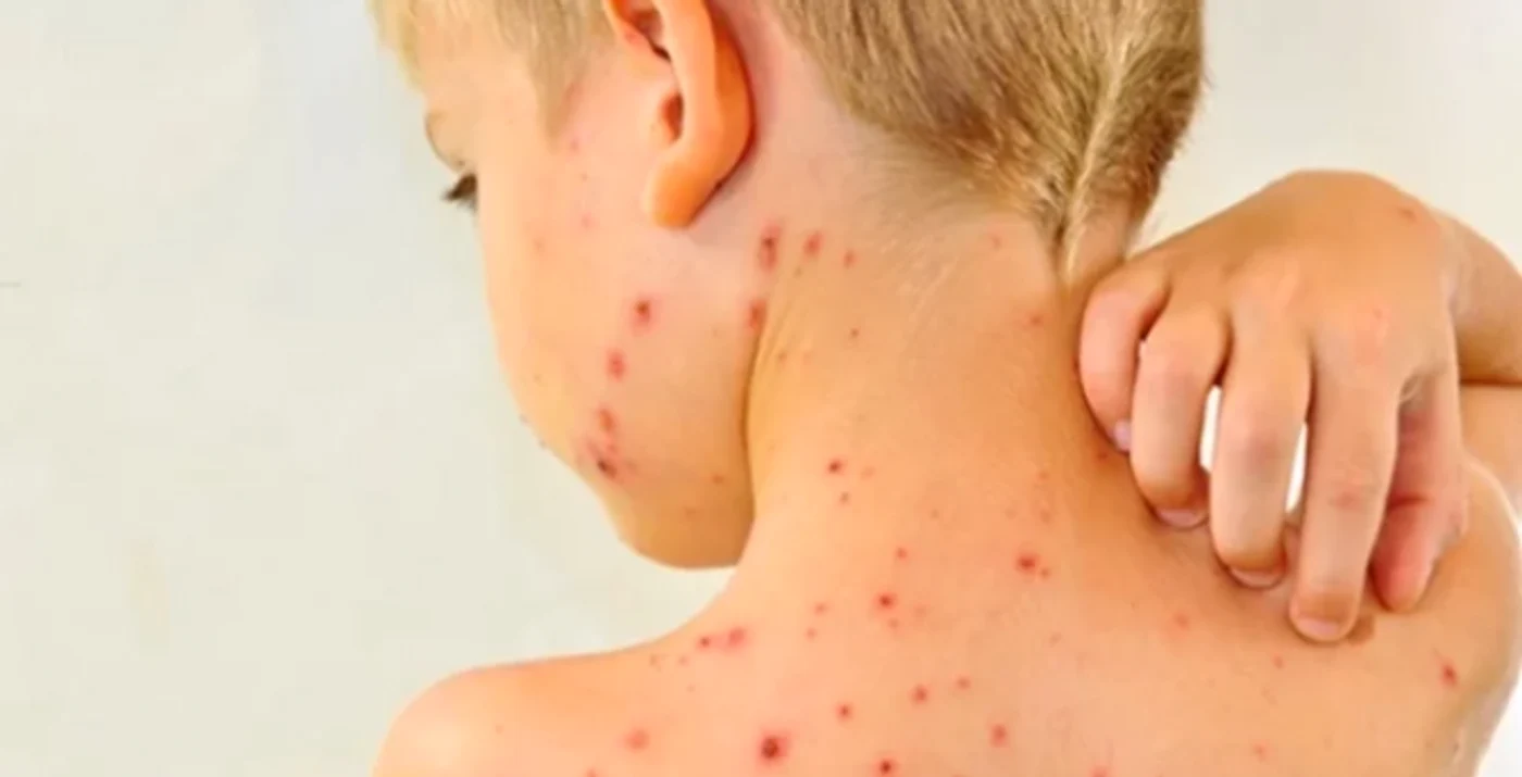 SUA se confruntă cu cea mai gravă epidemie de rujeolă din ultimii 30 de ani FOTO: Arhivă